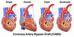 When Cabg Is Done?