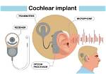 When Did Cochlear Implants Come out?