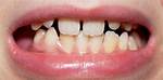 When Did Malocclusion Begin?