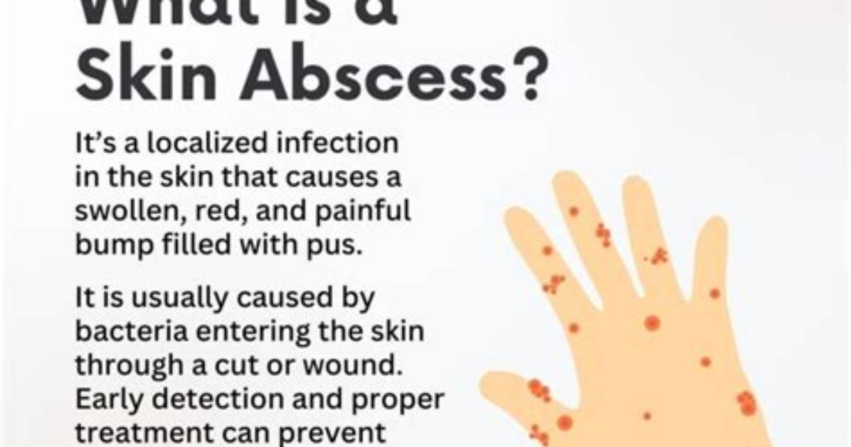 When Do Abscesses Go Away?