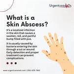 When Do Abscesses Go Away?
