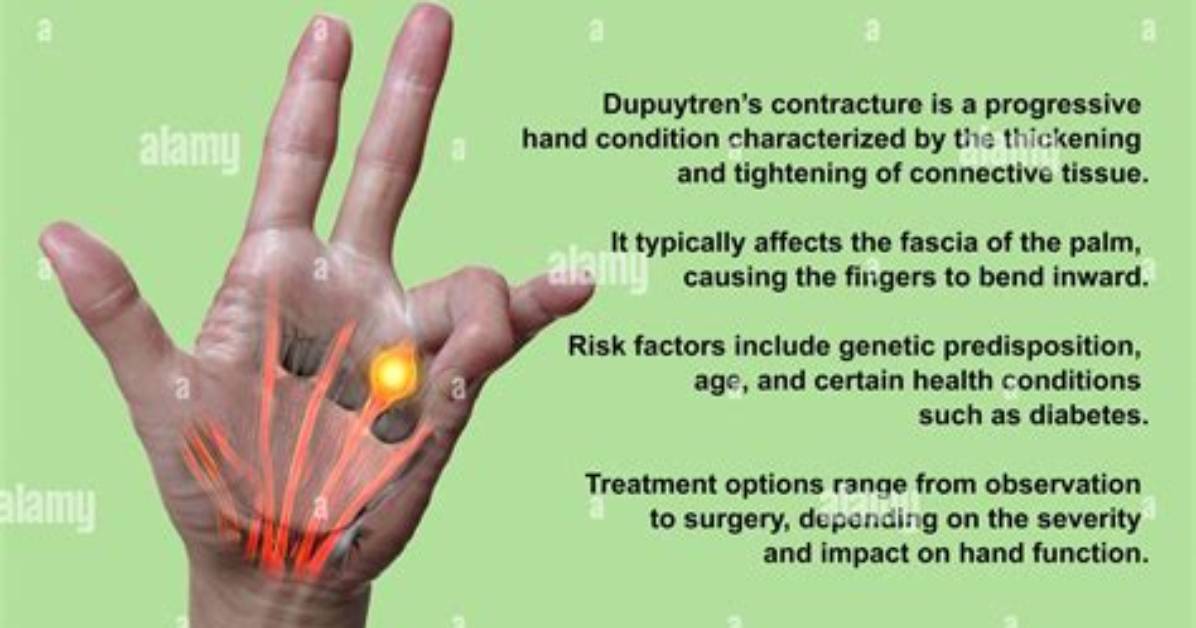 When Do Contractures Occur?