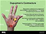 When Do Contractures Occur?
