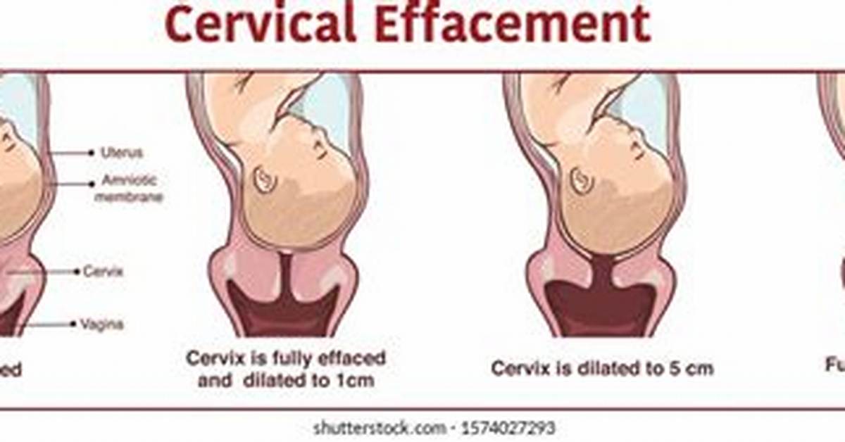 When Do Doctors Check for Effacement?