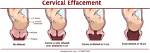 When Do Doctors Check for Effacement?