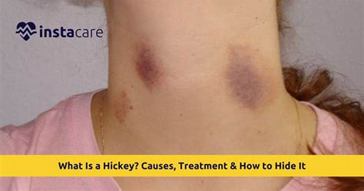 When Do Hickeys Show?