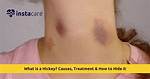 When Do Hickeys Show?