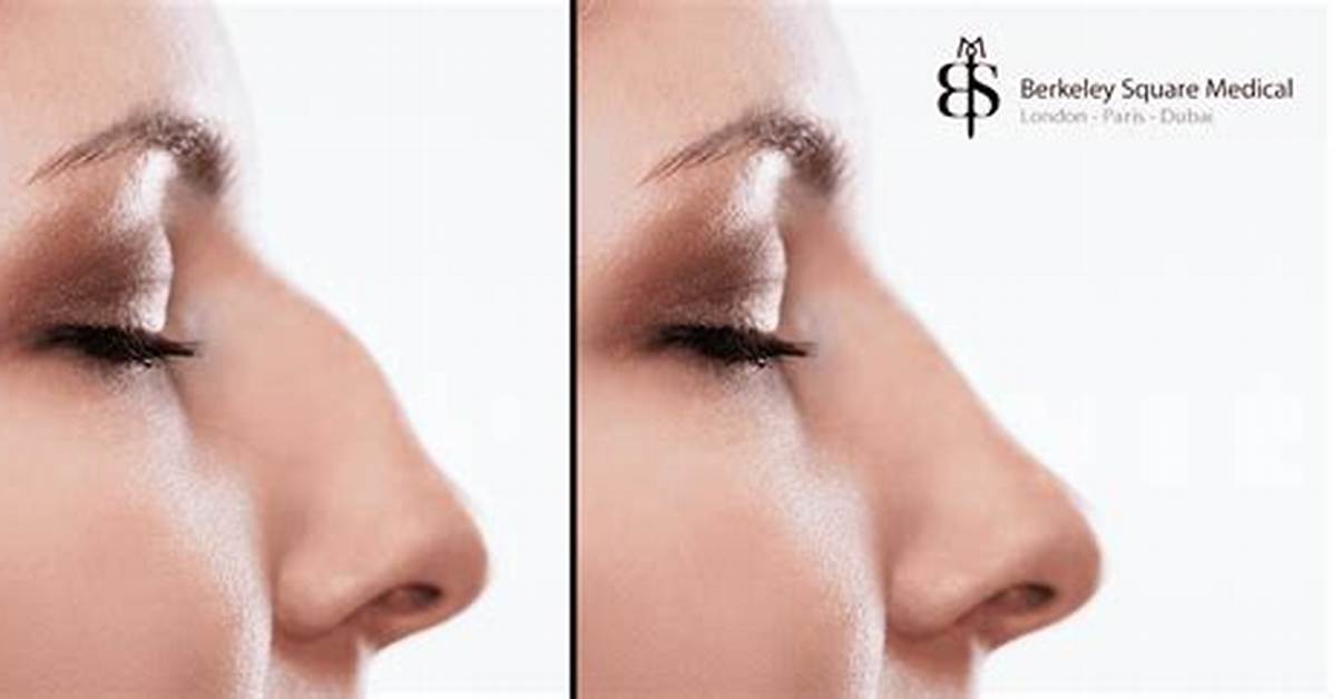 When Do Hook Noses Develop?