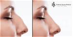 When Do Hook Noses Develop?