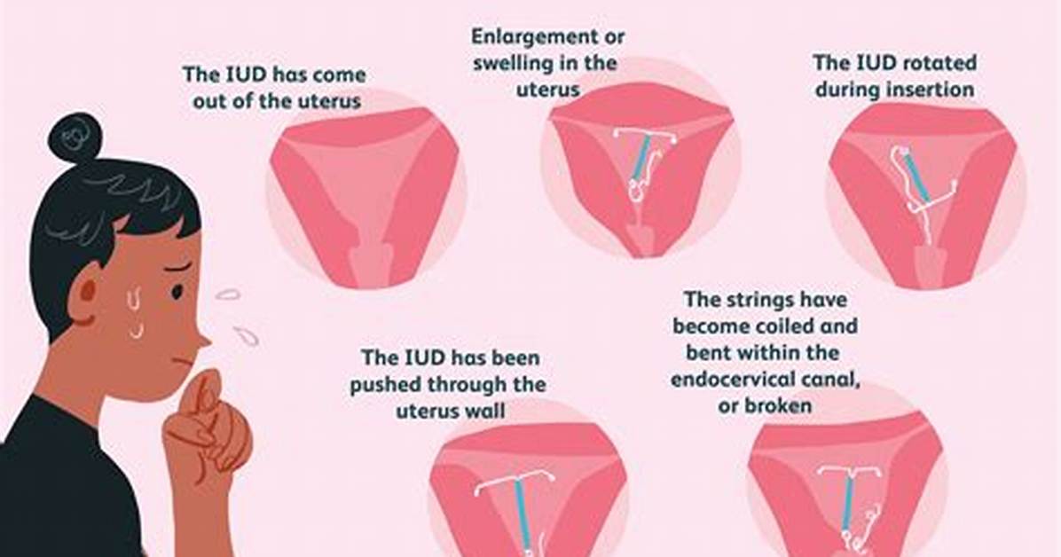 When Do Iuds Fail?