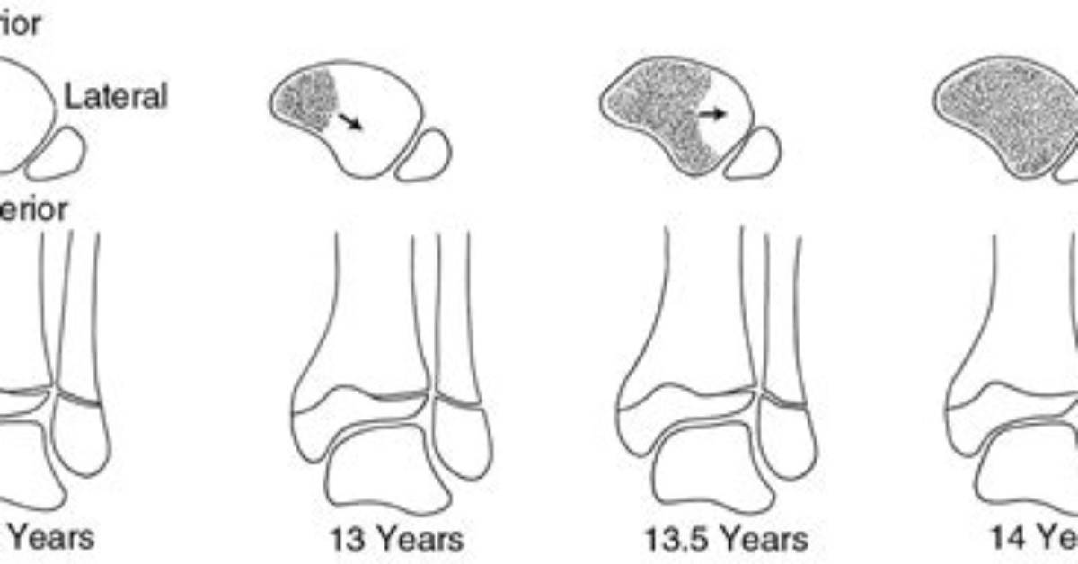 When Do Physis Closure?