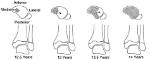 When Do Physis Closure?