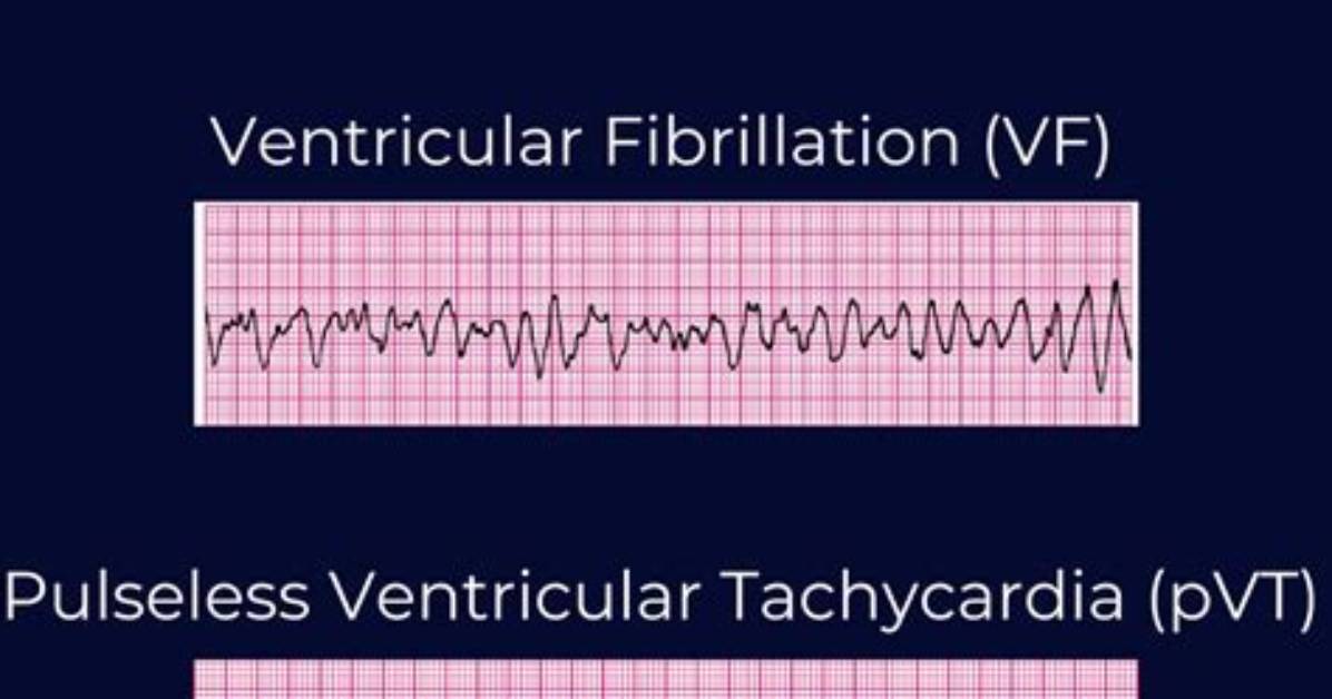When Do We Defibrillate?