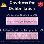 When Do We Defibrillate?