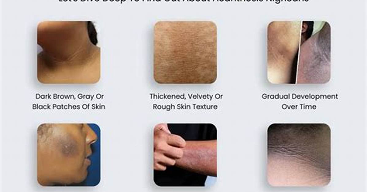 When Does Acanthosis Occur?