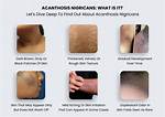 When Does Acanthosis Occur?