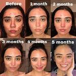 When Does Accutane Start Working