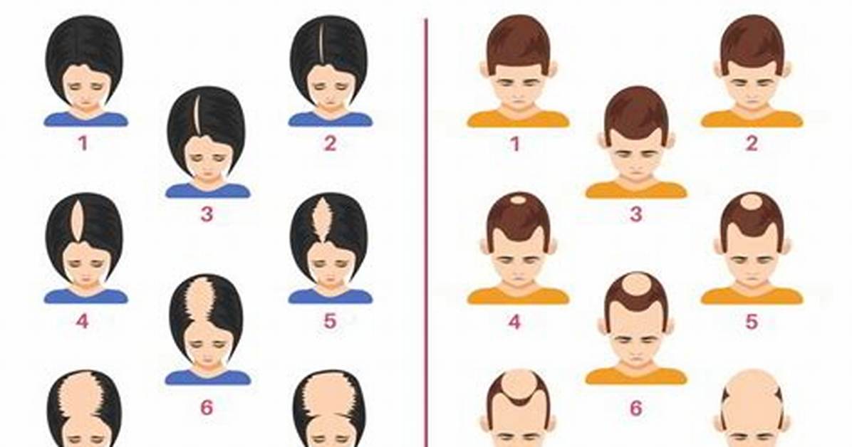 When Does Alopecia Start?