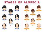 When Does Alopecia Start?