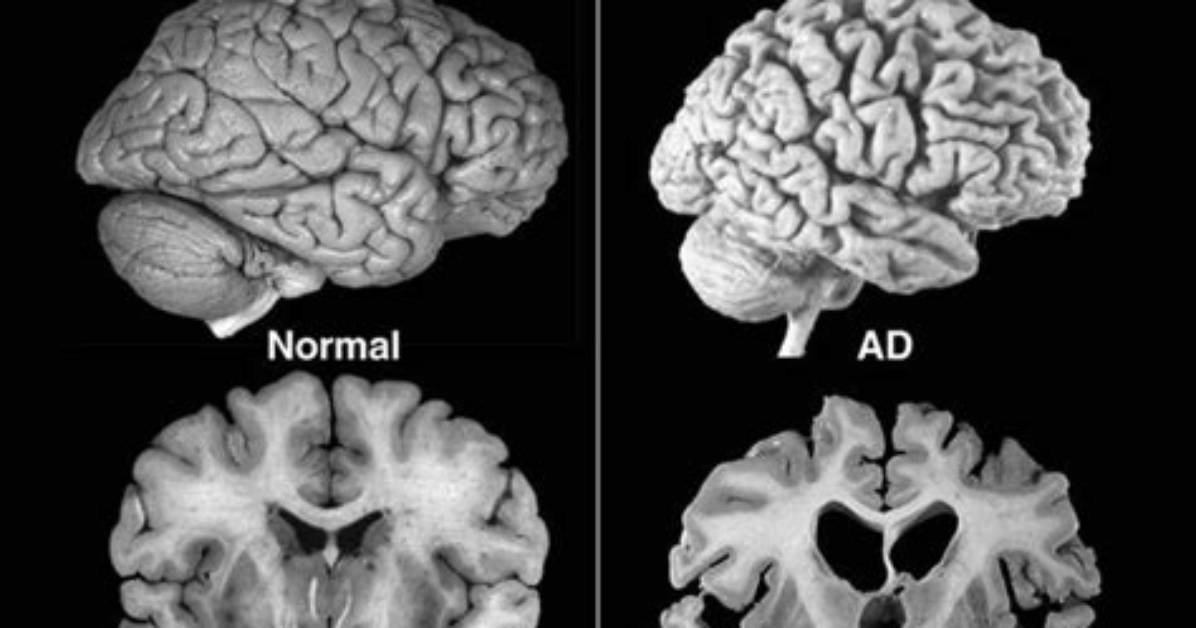 When Does Alzheimer's Kill?