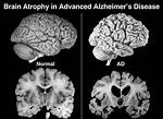 When Does Alzheimer's Kill?