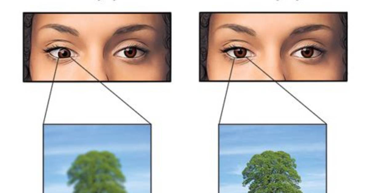 When Does Amblyopia Start?