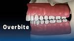 When Does an Overbite Need to Be Corrected?