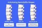 When Does Ankylosing Spondylitis Start?