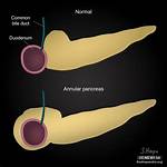 When Does Annular Pancreas Present?