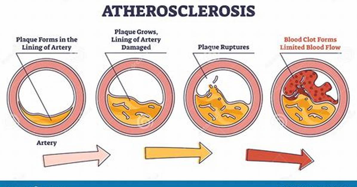 When Does Arteriosclerosis Typically Begin?