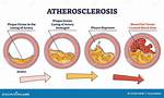 When Does Arteriosclerosis Typically Begin?