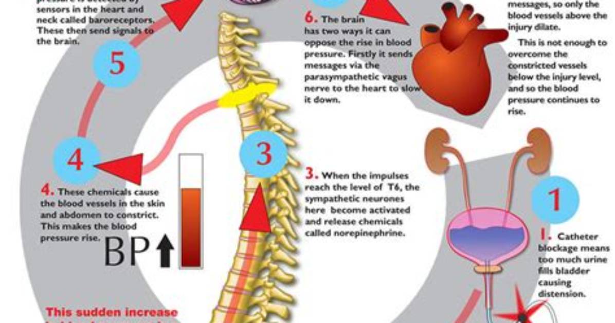 When Does Autonomic Hyperreflexia Occur?