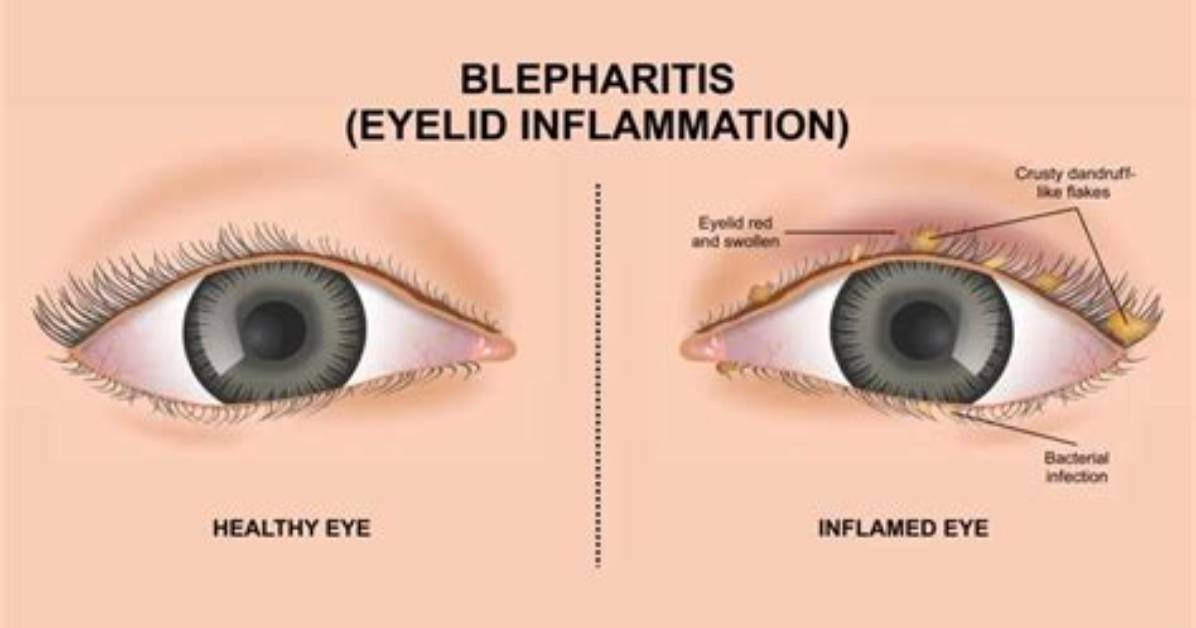 When Does Blepharitis Occur?