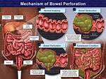When Does Bowel Perforation Occur?