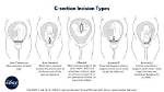 When Does C Section Incision Heal?