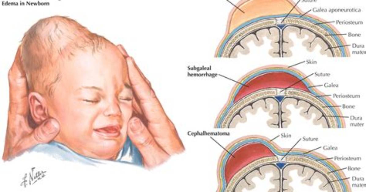 When Does Caput Succedaneum Resolve?