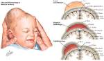 When Does Caput Succedaneum Resolve?