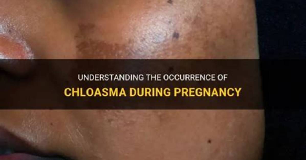 When Does Chloasma Occur?
