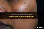 When Does Chloasma Occur?
