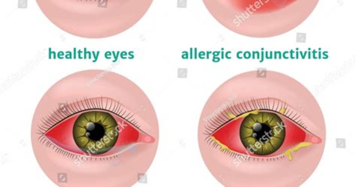 When Does Conjunctivitis Stop Being Contagious?