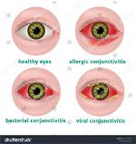 When Does Conjunctivitis Stop Being Contagious?