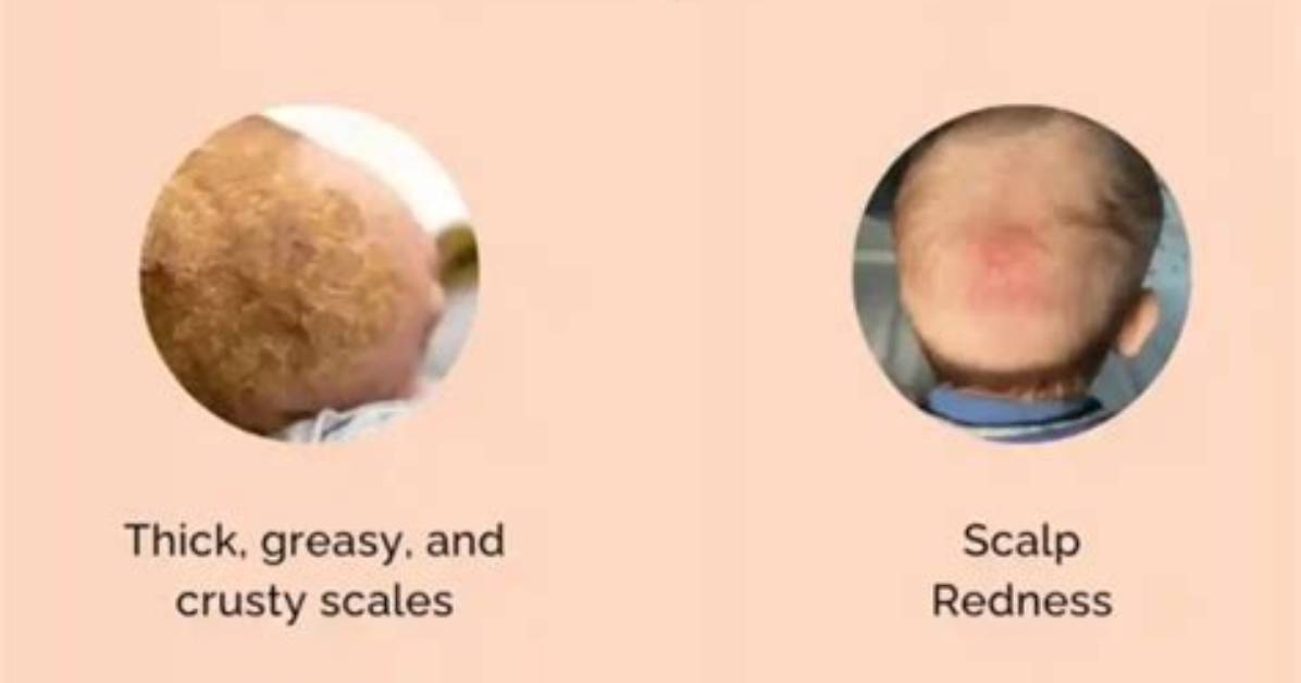 When Does Cradle Cap Stop?