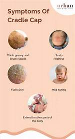 When Does Cradle Cap Stop?