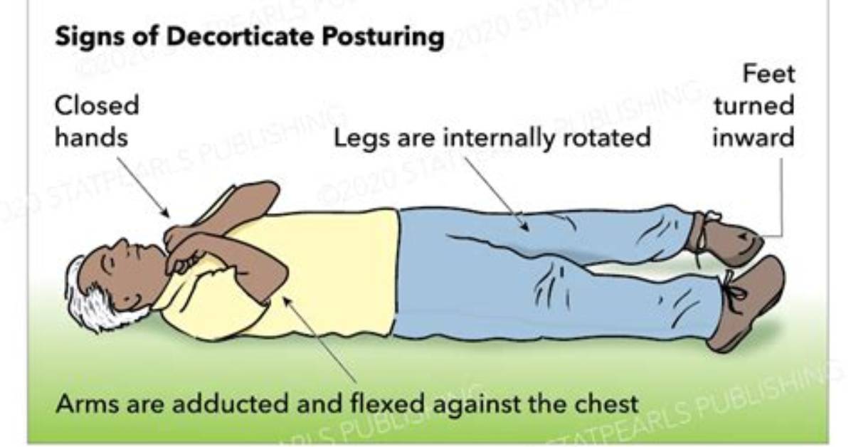 When Does Decorticate Posturing Occur?
