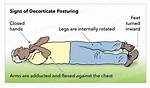 When Does Decorticate Posturing Occur?