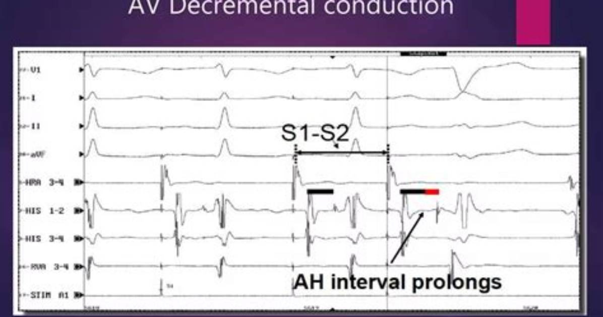 When Does Decremental Conduction Occur?