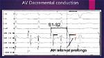 When Does Decremental Conduction Occur?