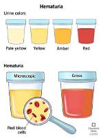 When Does Hematuria Appear?