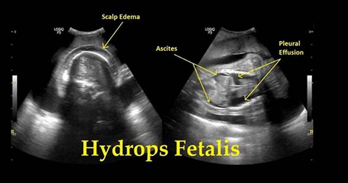 When Does Hydrops Occur?