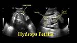 When Does Hydrops Occur?